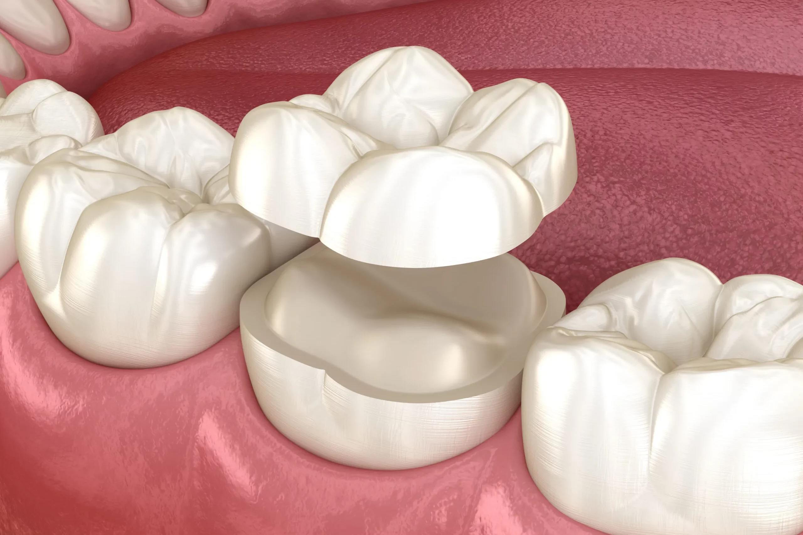 Make a Smile Dental Crowns