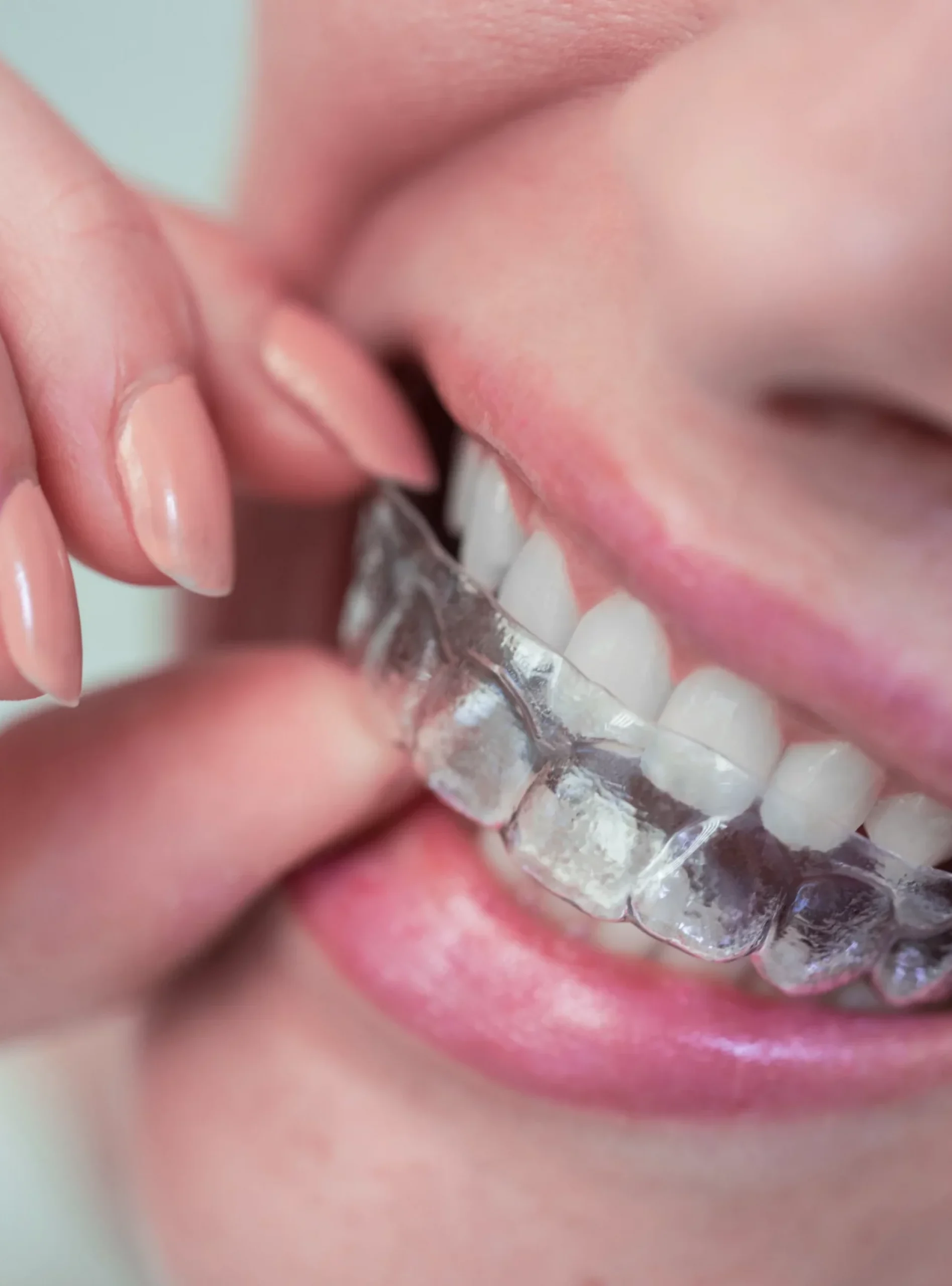 Make-a-Smile-Invisalign-scaled